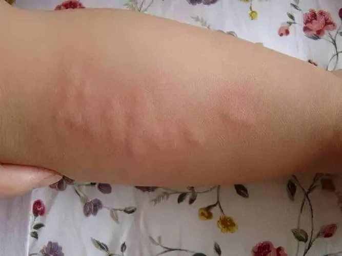 一周岁孩子送什么比较好,一周岁孩子荨麻疹怎么治疗
