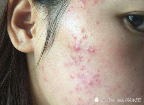 十二三岁女孩子送什么礼物,十二三岁的女孩子长痘痘什么原因